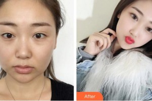 唐山灤縣人民醫(yī)院美容整形科齊向梅整形價(jià)格表附埋線提升案例展示