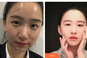 唐山市人民醫(yī)院燒傷整形科謝學(xué)峰整形價(jià)格表附激光祛斑案例展示