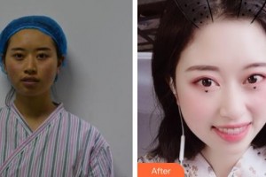 唐山聯(lián)合麗珍醫(yī)療美容門診部張德相整形價(jià)格表附埋線提升案例展示