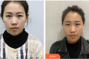 唐山星范醫(yī)療美容門診部高圣明整形價(jià)格表附埋線提升案例展示