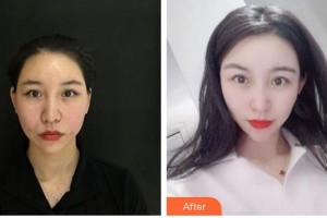 唐山星范醫(yī)療美容門診部王海艷整形價(jià)格表附埋線提升案例展示