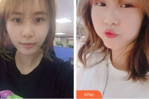 唐山祥云京城皮膚醫(yī)院董春蒼整形價(jià)格表附埋線提升案例展示