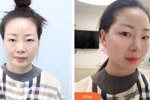 唐山煤醫(yī)整形美容醫(yī)院馬文超整形價(jià)格表附埋線提升案例展示