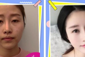 唐山光明醫(yī)院宋東軍整形價(jià)格表附切開雙眼皮案例展示