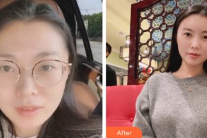 ?？诖鼷愥t(yī)療美容診所王延民整形價(jià)格表附自體脂肪填充案例展示