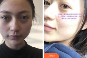 秦皇島紀(jì)輝整形美容醫(yī)院紀(jì)輝整形價格表附激光點痣案例展示