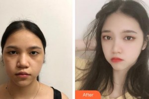 秦皇島紀(jì)輝整形美容醫(yī)院王雯整形價格表附去痘印痘坑案例展示