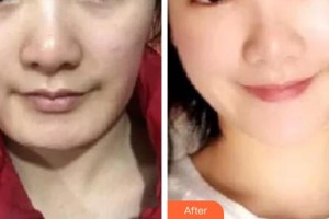 秦皇島巧致美容醫(yī)院張永國整形價格表附埋線提升案例展示