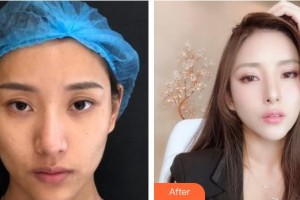 秦皇島紀(jì)輝整形美容醫(yī)院鄭杰整形價格表附埋線提升案例展示