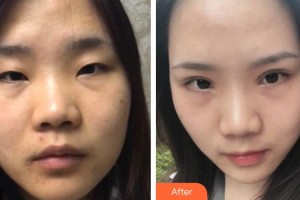 秦皇島巧致美容醫(yī)院于民整形價格表附切開雙眼皮案例展示