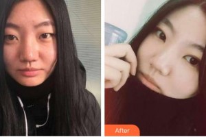 秦皇島紀(jì)輝整形美容醫(yī)院崔炳龍教授整形價格表附埋線雙眼皮案例展示