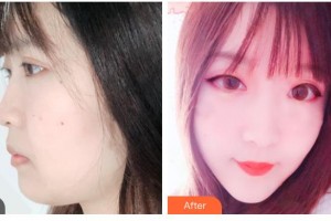 秦皇島友誼醫(yī)院整形美容外科王國光整形價格表附埋線提升案例展示