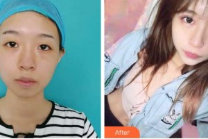 秦皇島紀輝整形美容醫(yī)院廉樂天整形價格表附眼部綜合案例展示