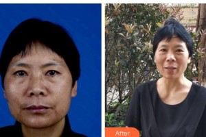 秦皇島巧致美容醫(yī)院張凱華整形價格表附微針美膚案例展示