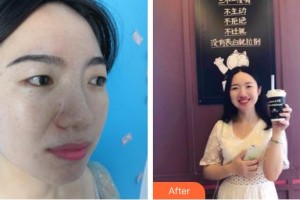 秦皇島釹娃（原女娃）醫(yī)療美容診所張曉陽整形價格表附光子嫩膚案例展示