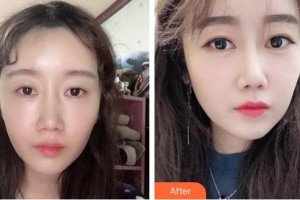 秦皇島東方皮膚醫(yī)學門診部王彩霞整形價格表附去痘印痘坑案例展示