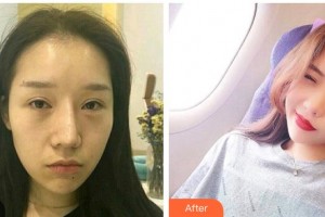 秦皇島慈善醫(yī)院整形美容科岳紅利整形價格表附肋軟骨隆鼻案例展示