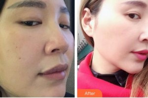 秦皇島愛爾眼科醫(yī)院王東英整形價格表附鼻部綜合案例展示