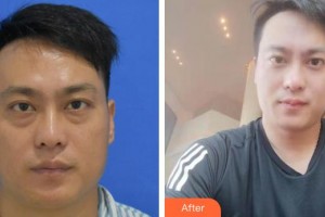 秦皇島愛爾眼科醫(yī)院張海東整形價格表附激光去眼袋案例展示