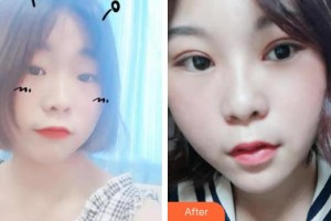 秦皇島美姿嬌醫(yī)療美容診所李金海整形價格表附眼部綜合案例展示