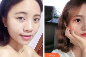 秦皇島愛爾眼科醫(yī)院薛巖整形價格表附眼部綜合案例展示