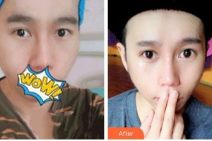 秦皇島愛爾眼科醫(yī)院劉秀整形價格表附切開雙眼皮案例展示