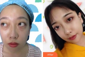 秦皇島巧致整形醫(yī)院周海燕整形價格表附內(nèi)切祛眼袋案例展示