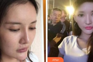 秦皇島巧致美容醫(yī)院田肖南整形價格表附埋線提升案例展示