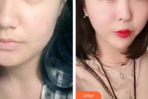 秦皇島東方皮膚醫(yī)學(xué)門診部馬嚴整形價格表附埋線提升案例展示