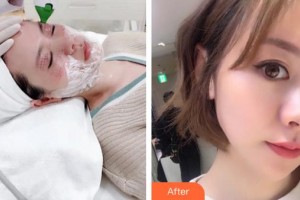 邯鄲雅乾醫(yī)療美容診所劉紅艷整形價格表附熱瑪吉案例展示