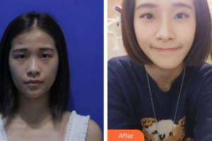 邯鄲華美醫(yī)療美容醫(yī)院李庭勛整形價格表附鼻中隔軟骨隆鼻案例展示