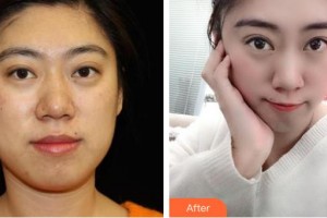 邯鄲華美醫(yī)療美容醫(yī)院常春整形價格表附熱瑪吉案例展示