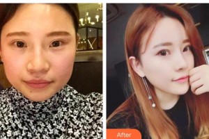 邯鄲現(xiàn)代麗人醫(yī)院整形美容中心陳逸華整形價格表附肋軟骨隆鼻案例展示