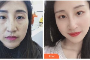 邯鄲都市整形美容醫(yī)院董春姬整形價格表附激光去眼袋案例展示