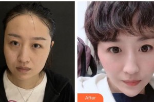 邯鄲曲勝星范醫(yī)療美容門診部曲勝整形價格表附埋線提升案例展示