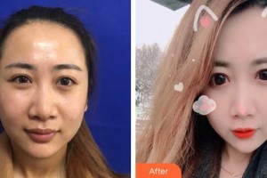 邢臺(tái)美在人生（原美聯(lián)臣）醫(yī)療美容診所韓晗整形價(jià)格表附埋線(xiàn)提升案例展示