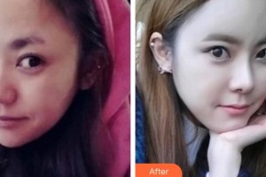 邢臺(tái)美在人生（原美聯(lián)臣）醫(yī)療美容診所王寶薔整形價(jià)格表附埋線(xiàn)提升案例展示