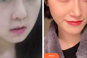 保定藍(lán)山醫(yī)療美容醫(yī)院王儉整形價格表附埋線提升案例展示