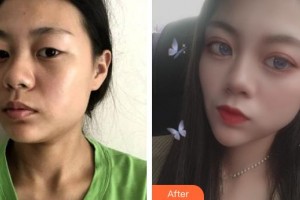 保定寶特醫(yī)療美容診所梁騫整形價格表附埋線提升案例展示