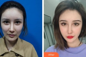 保定世紀(jì)協(xié)和醫(yī)院整形美容中心崔鵬程整形價格表附埋線提升案例展示