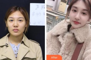 保定珍潤醫(yī)療美容門診部何棟良整形價格表附肋軟骨隆鼻案例展示