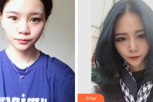 保定珍潤醫(yī)療美容門診部王保生整形價格表附鼻部綜合案例展示