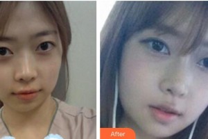 保定藍山醫(yī)療美容醫(yī)院杜建龍整形價格表附假體隆鼻案例展示