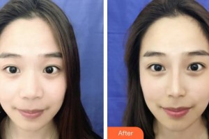 保定藍山醫(yī)療美容醫(yī)院劉海濤整形價格表附鼻部綜合案例展示