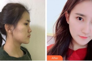 保定華仁皮膚病醫(yī)院激光美容中心李娟整形價格表附鼻部綜合案例展示