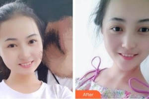 保定華美整形美容醫(yī)院高義豆整形價格表附冷光美白案例展示