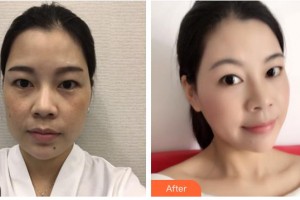 保定藍山醫(yī)療美容醫(yī)院任莉整形價格表附激光美膚激光案例展示