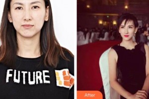 保定葉美思醫(yī)療美容診所霍玉釧整形價格表附超聲提拉案例展示