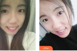 保定珍潤醫(yī)療美容門診部王博謙整形價格表附眼部綜合案例展示