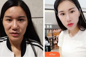 保定藍(lán)山醫(yī)療美容醫(yī)院于慧整形價格表附切開雙眼皮案例展示